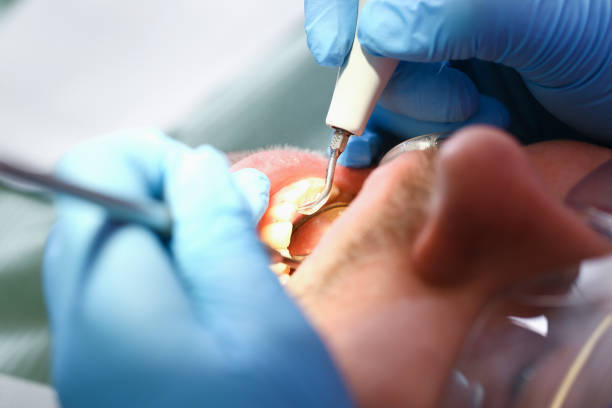 Best Emergency Wisdom Teeth Removal in Colbert, OK