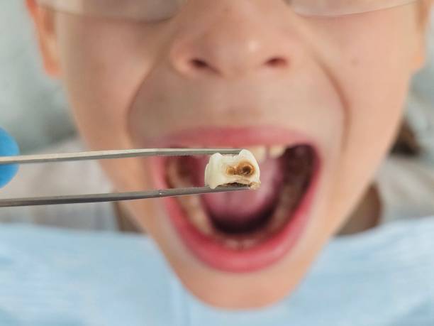 Best Emergency Treatment for Dental Infections or Abscesses in Colbert, OK